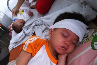 Cách nhận biết sớm và điều trị bệnh sởi cho trẻ